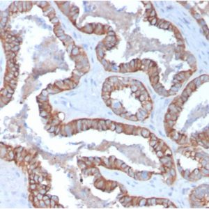 Formalin-fixed, paraffin-embedded human Prostate Carcinoma stained with Cytokeratin 15 Mouse Monoclonal Antibody (KRT15/2957)