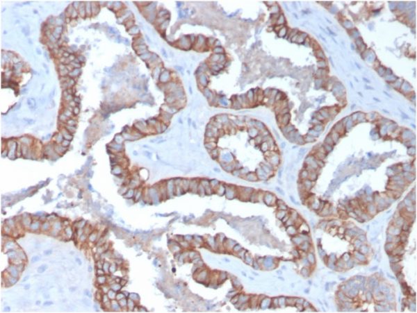 Formalin-fixed, paraffin-embedded human Prostate Carcinoma stained with Cytokeratin 15 Mouse Monoclonal Antibody (KRT15/2957)