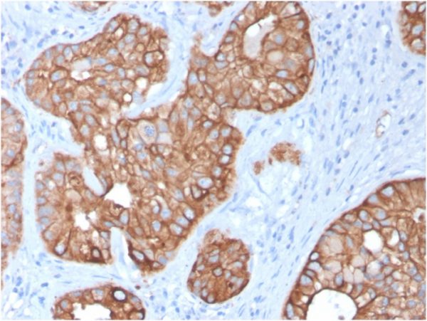 Formalin-fixed, paraffin-embedded human Colon Carcinoma stained with Cytokeratin 15 Mouse Monoclonal Antibody (KRT15/2957)