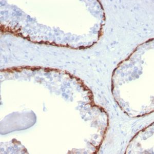 Formalin-fixed, paraffin-embedded human Prostate Carcinoma stained with Cytokeratin 15 Mouse Monoclonal Antibody (KRT15/2959)