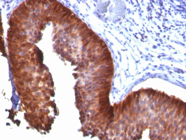 Formalin-fixed, paraffin-embedded human Bladder Carcinoma stained with CK17 Mouse Monoclonal Antibody (E3).