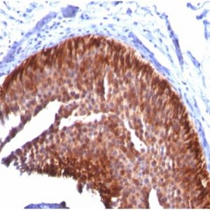 Formalin-fixed, paraffin-embedded human bladder carcinoma stained with CK17 Mouse Monoclonal Antibody (KRT17/778).