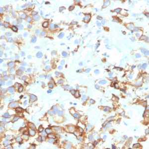 Formalin-fixed, paraffin-embedded human bladder carcinoma stained with CK17 Mouse Monoclonal Antibody (KRT17/4604).
