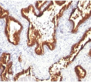 Formalin-fixed, paraffin-embeddedhuman prostate carcinoma stained with Cytokeratin 18 Mouse Monoclonal Antibody (KRT18/1190).