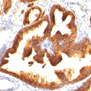 Formalin-fixed, paraffin-embedded human Prostate Carcinoma stained with Cytokeratin 18 Mouse Monoclonal Antibody (KRT18/836).