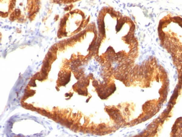 Formalin-fixed, paraffin-embedded human Prostate Carcinoma stained with Cytokeratin 18 Mouse Monoclonal Antibody (KRT18/836).