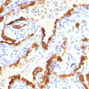 Formalin-fixed, paraffin-embedded human Lung Ca stained with Cytokeratin 18 Mouse Monoclonal Antibody (Cocktail).