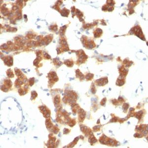 Formalin-fixed, paraffin-embedded Thyroid Carcinoma stained with Cytokeratin 18 Monoclonal Antibody (B23.1).
