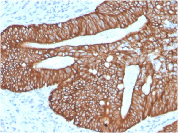 Formalin-fixed, paraffin-embedded human Colon Carcinoma stained with Cytokeratin 18Rabbit Recombinant Monoclonal Antibody (KRT18/2819R).