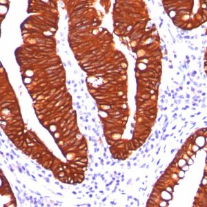 Formalin-fixed, paraffin-embedded colon carcinoma stained with Cytokeratin 19 Mouse Monoclonal Antibody (A53-B/A2.26).
