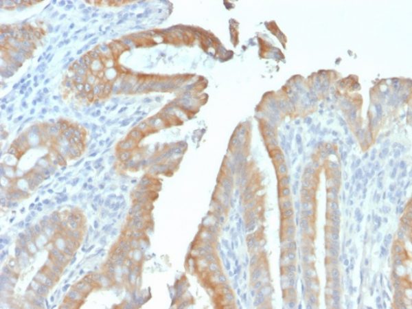 Formalin-fixed, paraffin-embedded human Colon Carcinoma stained with Cytokeratin 19 Mouse Recombinant Monoclonal Antibody (rKRT19/799).