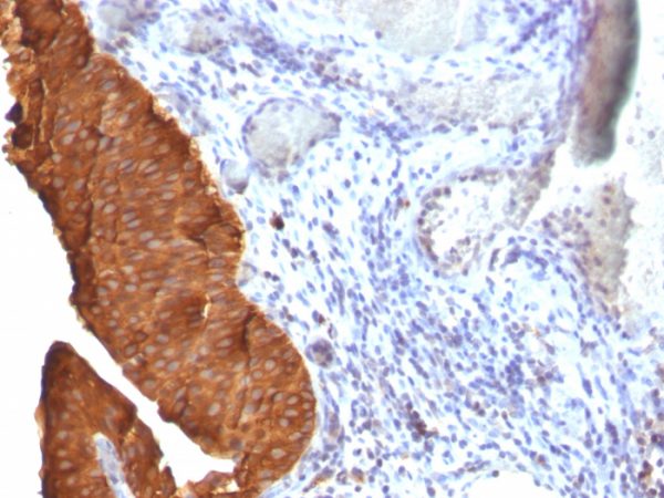 Formalin-fixed, paraffin-embedded human Bladder Carcinoma stained with Cytokeratin 19 Monoclonal Antibody (SPM561)