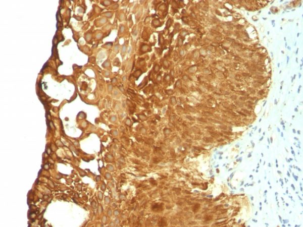 Formalin-fixed, paraffin-embedded human Cervical Carcinoma stained with Cytokeratin 19 Mouse Monoclonal Antibody (KRT19/799).