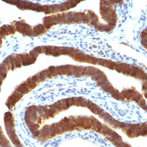 Formalin-fixed, paraffin-embedded human Ovarian Carcinoma stained with Cytokeratin 19 Ab (Ks19.1)