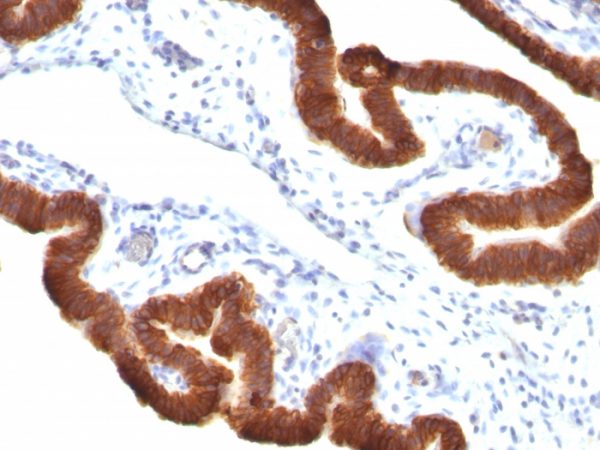 Formalin-fixed, paraffin-embedded human Ovarian Carcinoma stained with Cytokeratin 19 Monoclonal Antibody (KRT19/799 + KRT19/800)