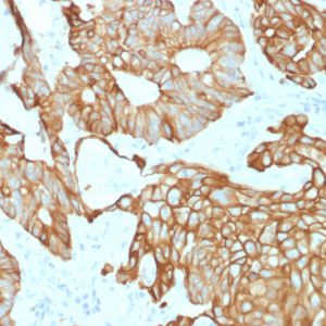 Formalin-fixed, paraffin-embedded human Colon Carcinoma stained with CK19 Mouse Recombinant Monoclonal Antibody (rKRT19/800).