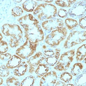 Formalin-fixed, paraffin-embedded human Renal Cell Carcinoma stained with Laminin Monoclonal Antibody (SPM193).