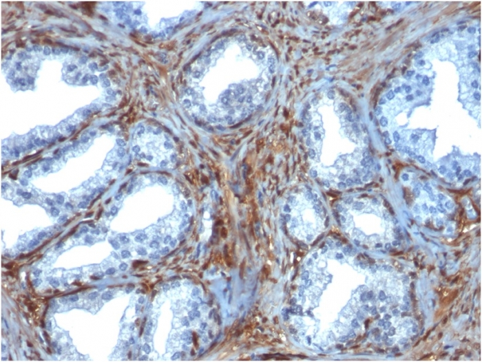 Formalin-fixed, paraffin-embedded human Prostate Carcinoma stained with Galectin-1 Monospecific Mouse Monoclonal Antibody (GAL1/1831). Galectin-1 / Human Placental Lactogen (hPL) Antibody