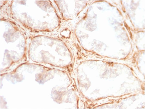 Formalin-fixed, paraffin-embedded human Prostate Carcinoma stained with Galectin-1 Monospecific Recombinant Rabbit Monoclonal Antibody (GAL1/2499R).