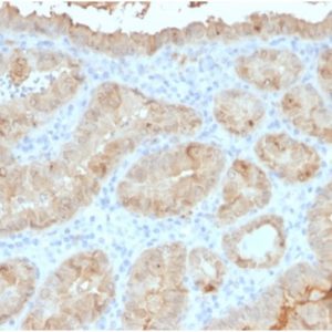 Formalin-fixed, paraffin-embedded human thyroid carcinoma stained with Galectin-3 Mouse Monoclonal Antibody (LGALS3/4792).