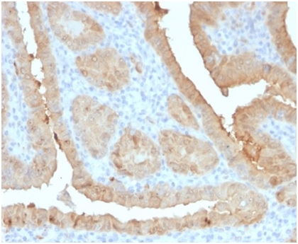 Formalin-fixed, paraffin-embedded human thyroid carcinoma stained with Galectin-3 Mouse Monoclonal Antibody (LGALS3/4792).
