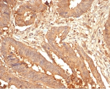 Formalin-fixed, paraffin-embedded human colon stained with LGALS3 Rabbit Recombinant Monoclonal Antibody (LGALS3/7036R). HIER: Tris/EDTA, pH9.0, 45min. 2 °: HRP-polymer, 30min. DAB, 5min.