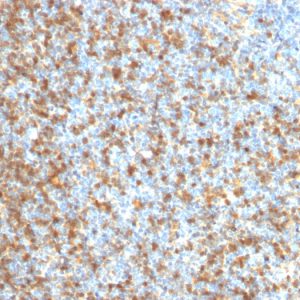 Formalin-fixed, paraffin-embedded human Follicular Lymphoma stained with LMO2 Mouse Monoclonal Antibody (LMO2/1971).