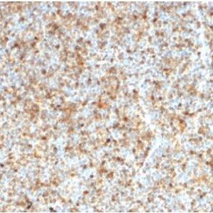 Formalin-fixed, paraffin-embedded human follicular lymphoma stained with LMO2 Mouse Monoclonal Antibody (LMO2/1972).
