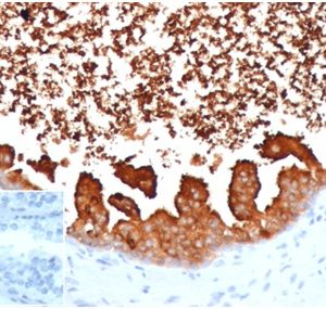 Formalin-fixed, paraffin-embedded human prostate carcinoma stained with Lactotransferrin Mouse Monoclonal Antibody (LTF/4075). Inset: PBS instead of primary, secondary negative control.