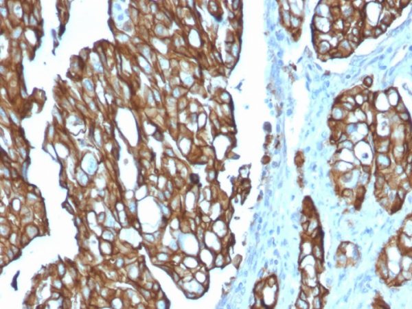 Formalin-fixed, paraffin-embedded human colon carcinoma stained with TACSTD2 / TROP2 Mouse Monoclonal Antibody (TACSTD2/2151).