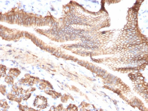 Formalin-fixed, paraffin-embedded human pancreatic carcinoma stained with TACSTD2 / TROP2 Mouse Monoclonal Antibody (TACSTD2/2151).