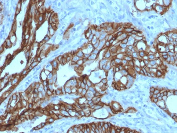 Formalin-fixed, paraffin-embedded human colon carcinoma stained with TACSTD2 / TROP2 Mouse Monoclonal Antibody (TACSTD2/2152).