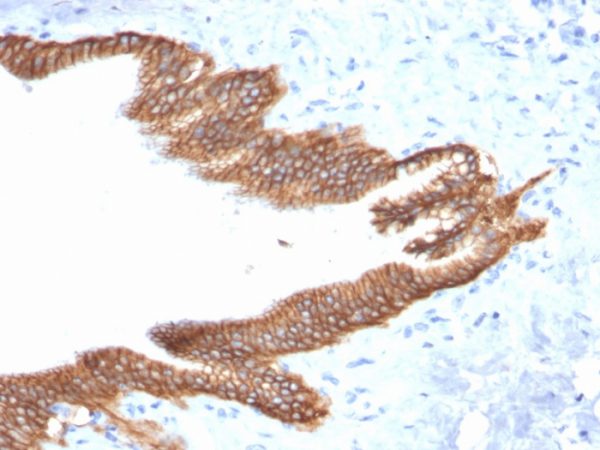 Formalin-fixed, paraffin-embedded human pancreatic carcinoma stained with TACSTD2 / TROP2 Mouse Monoclonal Antibody (TACSTD2/2152).