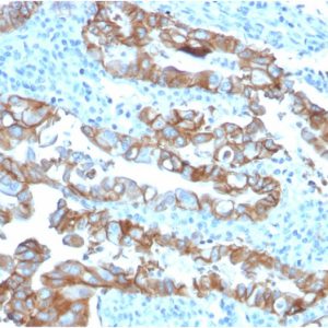Formalin-fixed, paraffin-embedded human Colon Carcinoma stained with TACSTD2-Monospecific Mouse Monoclonal Antibody (TACSTD2/2153).