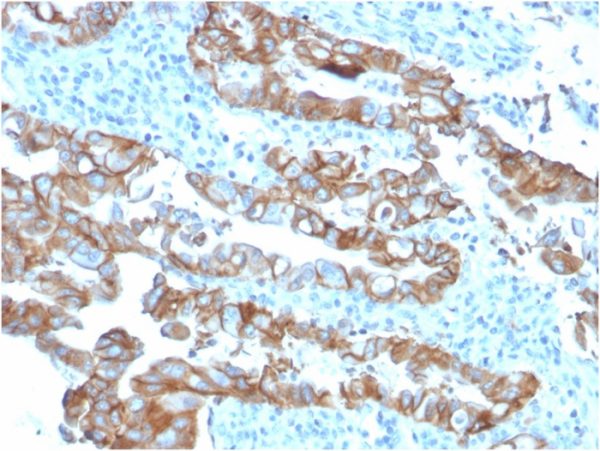 Formalin-fixed, paraffin-embedded human Colon Carcinoma stained with TACSTD2-Monospecific Mouse Monoclonal Antibody (TACSTD2/2153).