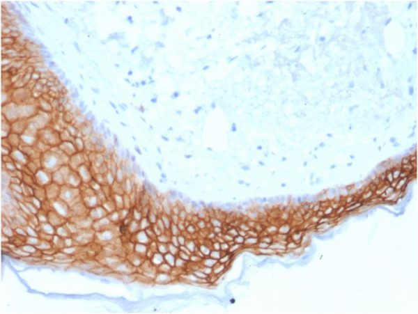 Formalin-fixed, paraffin-embedded human Basal Cell Carcinoma stained with TACSTD2-Monospecific Mouse Monoclonal Antibody (TACSTD2/2153).