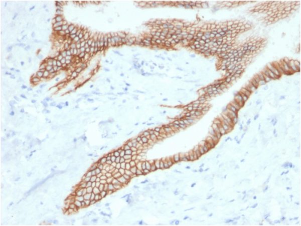 Formalin-fixed, paraffin-embedded human Pancreatic Carcinoma stained with TACSTD2-Monospecific Mouse Monoclonal Antibody (TACSTD2/2153).