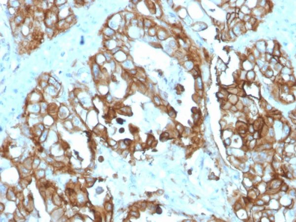 Formalin-fixed, paraffin-embedded human colon carcinoma stained with TACSTD2 Recombinant Mouse Monoclonal Antibody (rTACSTD2/6395).