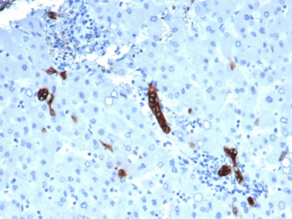 Formalin-fixed, paraffin-embedded human liver in colon carcinoma stained with TACSTD2 Recombinant Mouse Monoclonal Antibody (rTACSTD2/6395).