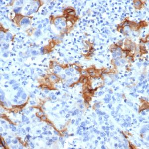 Formalin-fixed, paraffin-embedded human liver in colon carcinoma stained with TACSTD2 Recombinant Rabbit Monoclonal Antibody (TACSTD2/6394R).