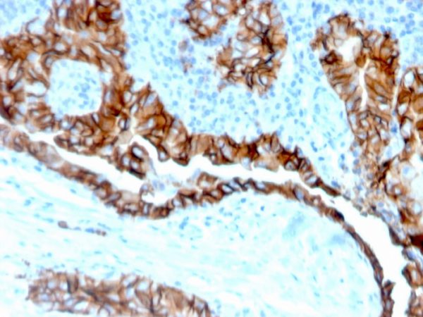 Formalin-fixed, paraffin-embedded human thyroid carcinoma stained with TACSTD2 Recombinant Rabbit Monoclonal Antibody (TACSTD2/6394R).
