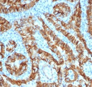 Formalin-fixed, paraffin-embedded human thyroid carcinoma stained with  TACSTD2 Recombinant Rabbit Monoclonal Antibody (TACSTD2/6396R).