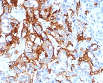 Formalin-fixed, paraffin-embedded human liver in colon carcinoma stained with  TACSTD2 Recombinant Rabbit Monoclonal Antibody (TACSTD2/6396R).
