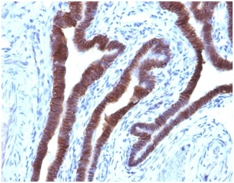 Formalin-fixed, paraffin-embeddedhuman ovarian carcinoma stained with EpCAM Mouse Monoclonal Antibody (EGP40/1110).