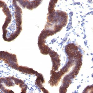 Formalin-fixed, paraffin-embedded human Ovarian Carcinoma stained with EpCAM Mouse Monoclonal Antibody (EGP40/1120).