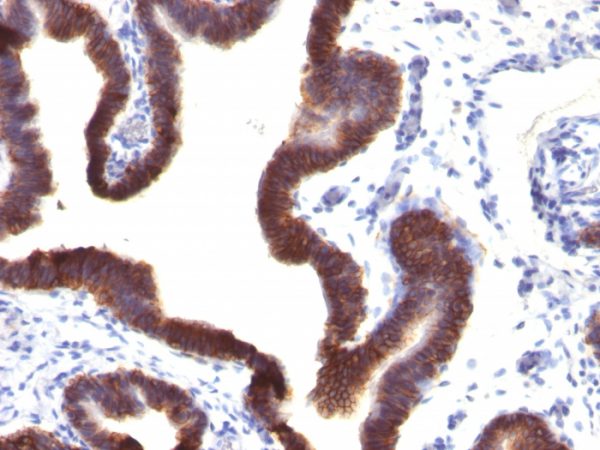 Formalin-fixed, paraffin-embedded human Ovarian Carcinoma stained with EpCAM Mouse Monoclonal Antibody (EGP40/1120).