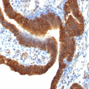 Formalin-fixed, paraffin-embedded human Ovarian Carcinoma stained with Ep-CAM Monoclonal Antibody (SPM491).