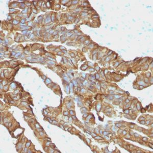 Formalin-fixed, paraffin-embedded human colorectal carcinoma stained with EpCAM-Monospecific Mouse Monoclonal Antibody (EGP40/1372).