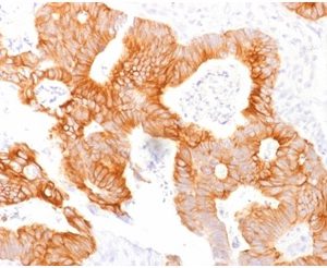 Formalin-fixed, paraffin-embedded human colorectal carcinomastained with Ep-CAMMouse Monoclonal Antibody (EGP40/1798).