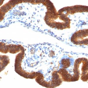 Formalin-fixed, paraffin-embedded human Ovarian Carcinoma stained with Ep-CAM Mouse Monoclonal Antibody (SPM134).